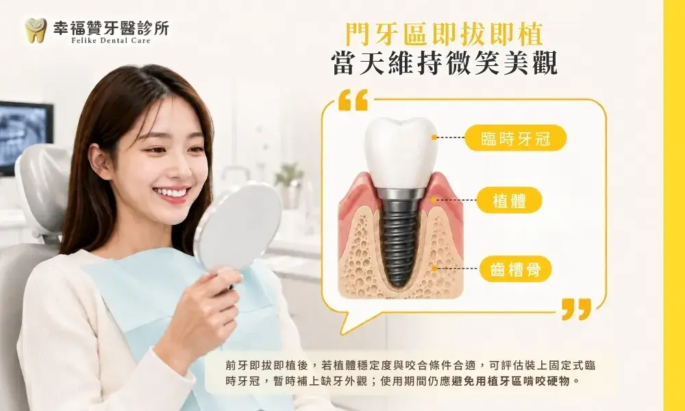 拔牙後能不能馬上植牙?即拔即植條件解析 2 門牙區即拔即植示意圖,展示植入植體與臨時牙冠以在當天維持微笑美觀。